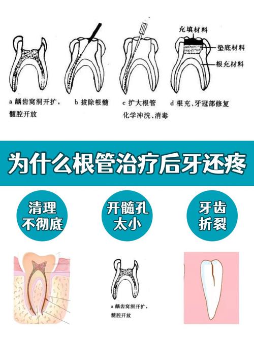 重庆根管治疗是种牙吗 别再混淆两者天差地别