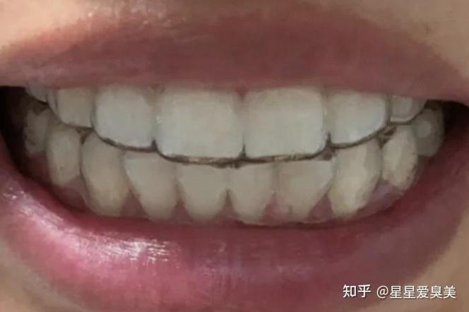 重庆24岁矫正牙齿要花多少钱 这笔钱到底值不值