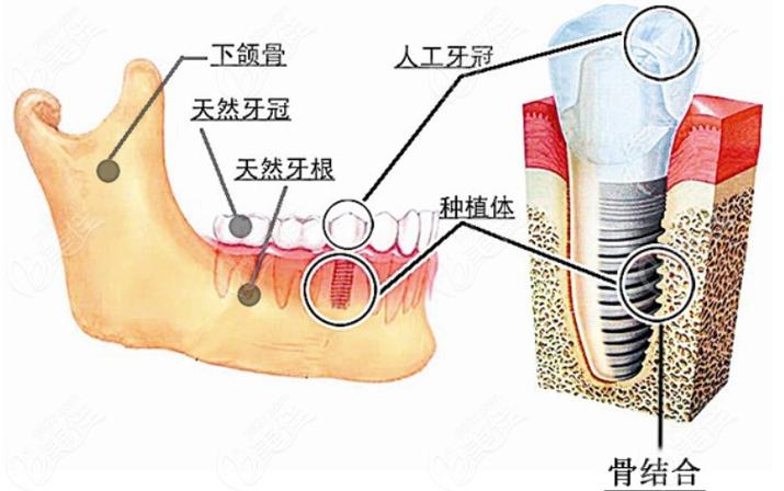 重庆深圳瑞士ITI种植牙 牙槽骨条件要求详解