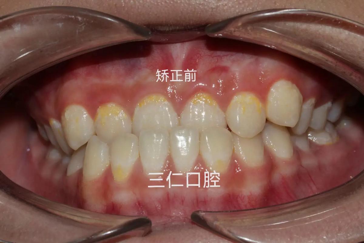 重庆种一颗牙矫正价格是多少 看完这篇心里有数