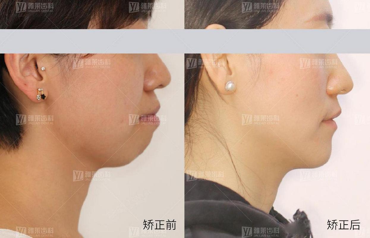 重庆矫正牙齿对脸型的改变到底有多大？真实对比告诉你