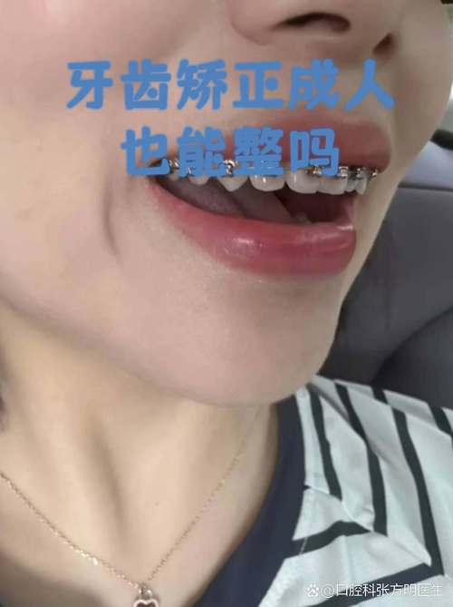重庆成人地包天牙齿矫正 成年人还能做吗效果好吗
