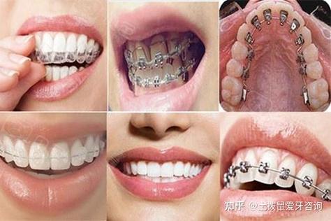 重庆34岁做牙齿矫正还来得及吗