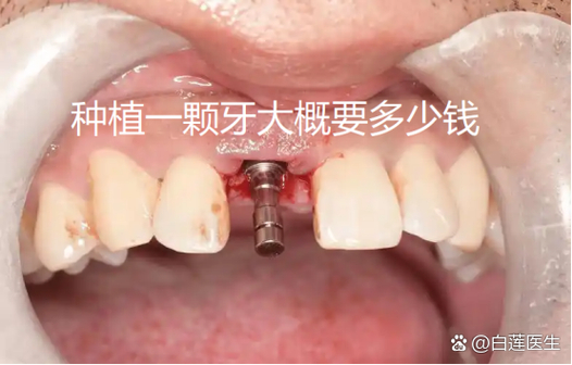 重庆纯钛种牙多少钱一颗?费用明细和影响因素都在这里