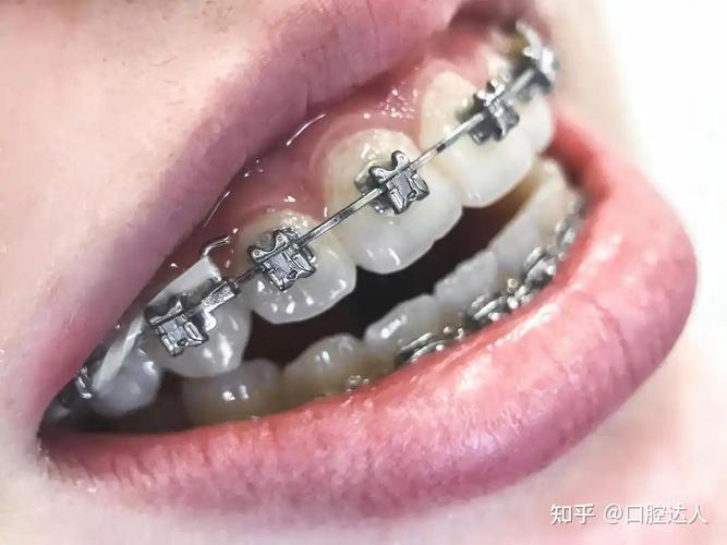 重庆矫正牙齿到底要花多少钱