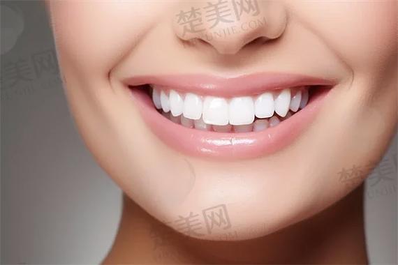 重庆杭州自锁牙齿矫正多少钱？真实费用全揭秘