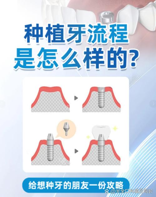 重庆上门牙种牙要多久 门牙种植美观又牢固