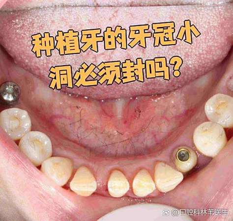 重庆深圳龙华全口种牙当天戴牙冠靠谱吗