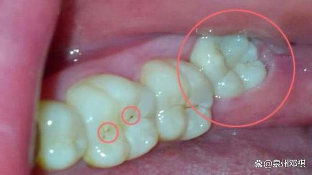 重庆拔牙后能马上种牙吗？看完这篇就懂了
