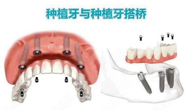 重庆种植牙还是搭桥哪个更好
