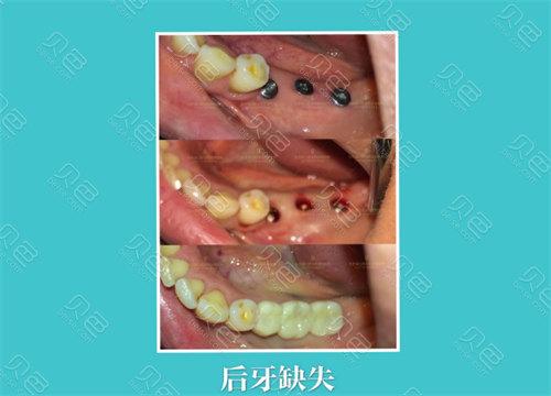 重庆龙岗中心城种植牙医院怎么选 本地人的真实推荐