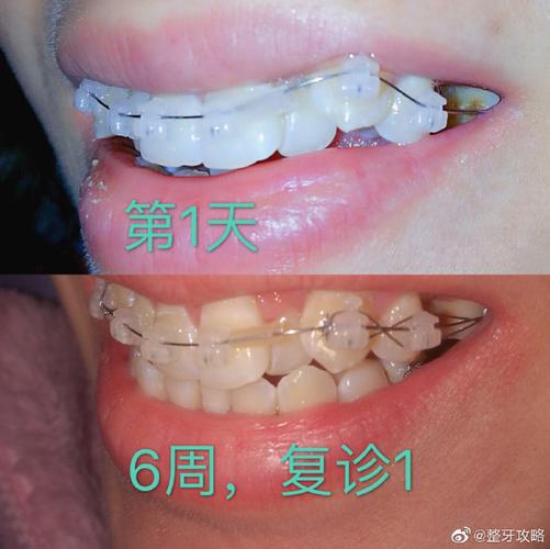 重庆深圳牙缝过大矫正多少钱 价格表一览
