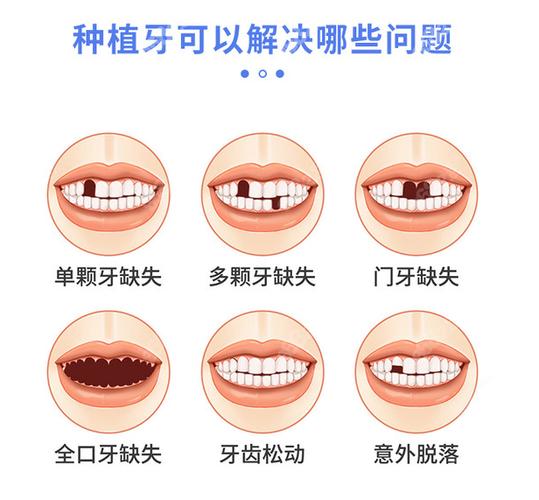 重庆宝安新安种植牙哪家医院好？靠谱选择看这几点