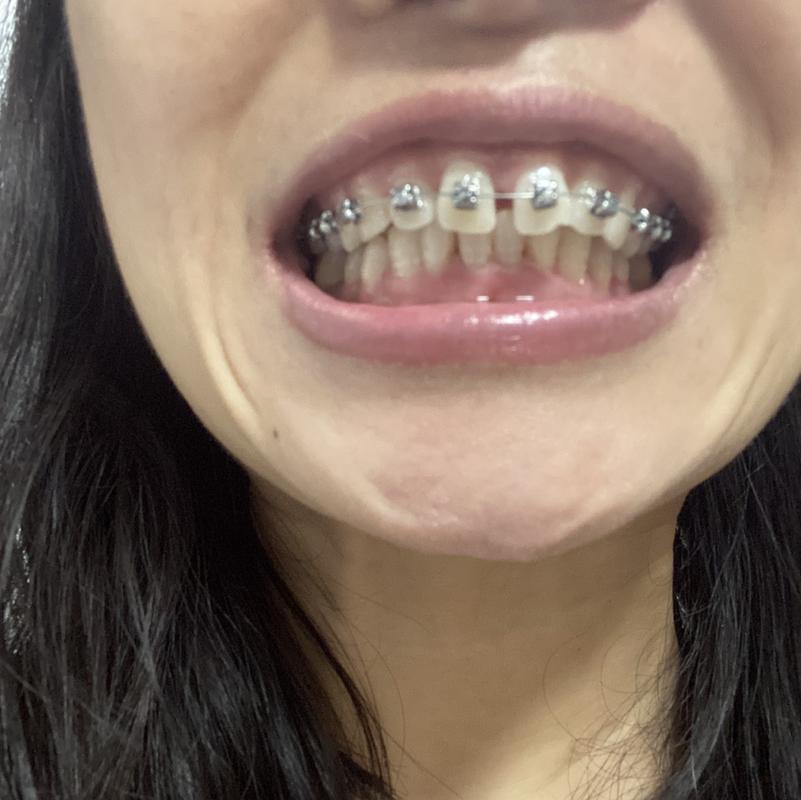 重庆40岁还能矫正牙齿吗？真实案例告诉你答案