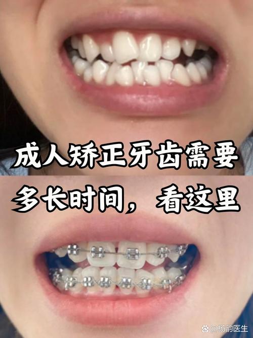 重庆41岁做牙齿矫正晚不晚？成人正畸真实经历分享