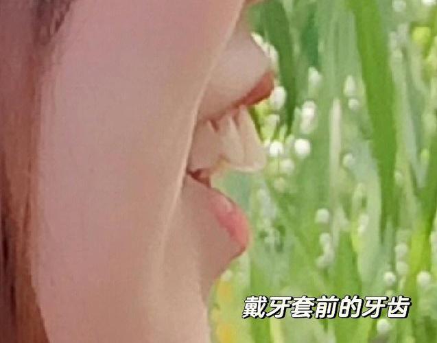 重庆深圳骨性龅牙正畸选哪家医院？骨科正畸避坑全攻略