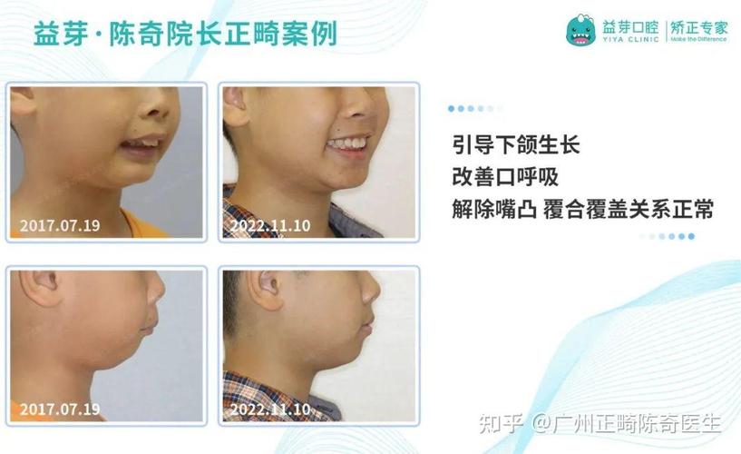 重庆东莞儿童牙齿矫正几岁开始最好？家长别等换完牙才后悔
