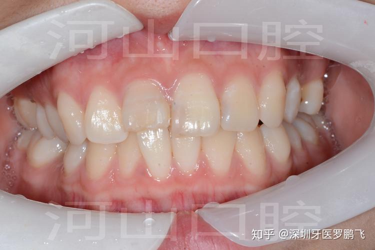 重庆20岁牙齿还能不能矫正？成年人正畸真实情况揭秘