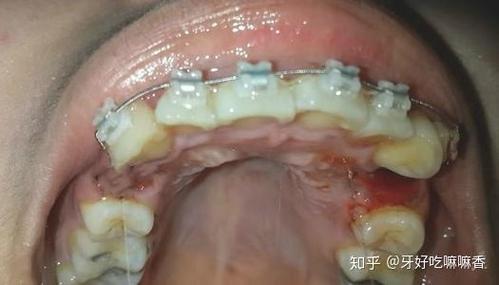 重庆宁波青少年牙齿矫正选哪家？费用多少？看完这篇就明白