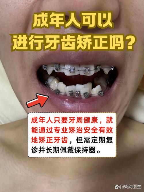 重庆30岁矫正牙齿还来得及吗 成年人正畸必看
