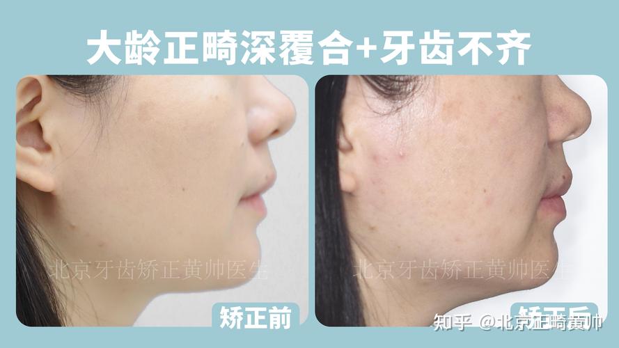 重庆45岁做深覆合矫正大概多少钱？费用明细全公开