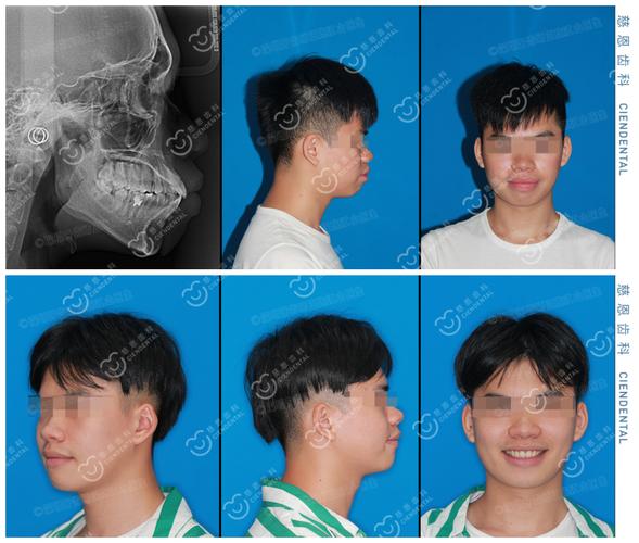 重庆深圳罗湖骨性龅牙隐形矫正能行吗？方案详解
