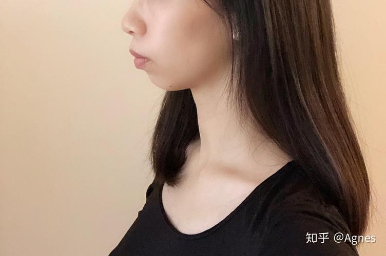 重庆深圳龙岗隐适美矫正要多久？看完这篇就清楚了