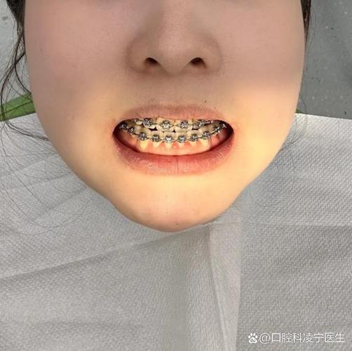 矫正突出门牙可以矫正吗_门牙突出矫正需要多长时间_50岁门牙突出可矫正吗