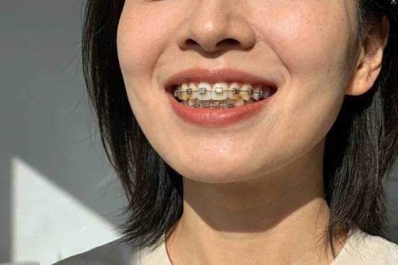重庆北京牙齿矫正费用揭秘：2026年一般要花多少钱？
