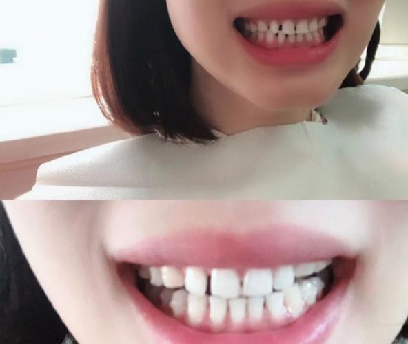 重庆成都钢丝矫正牙齿要多少钱？真实价格全曝光