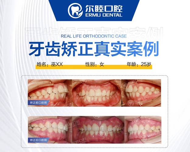 重庆深圳宝安金属自锁托槽矫正哪里好？公立和私立医院怎么选