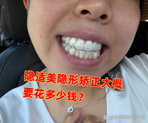 重庆深圳龙岗隐适美牙套多少钱？收费明细看这篇