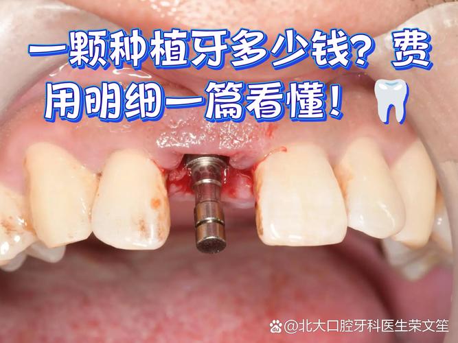 重庆深圳种牙贵不贵？揭秘诺贝尔种植牙门诊真实收费明细