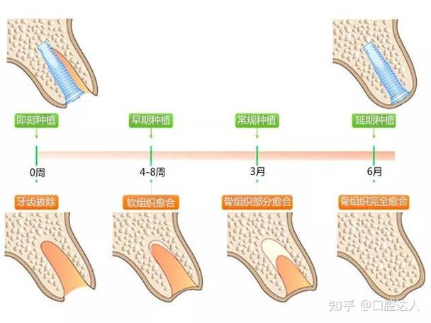 重庆掉3颗牙怎样种植？种牙流程全解析+费用避坑指南