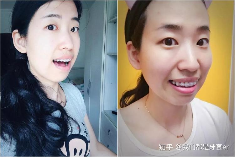 重庆30岁做牙齿矫正晚不晚？真实情况告诉你