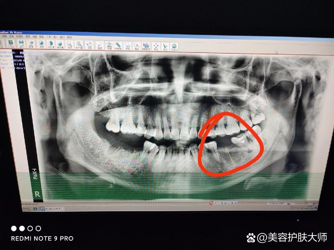 重庆深圳皓圣种植牙医院靠谱吗 真实推荐指南