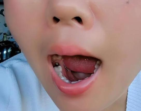 重庆55岁种牙好还是镶牙好？一文告诉你答案