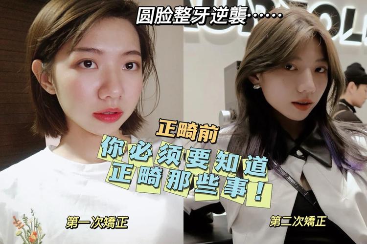 重庆23岁整牙还来得及吗？过来人说实话