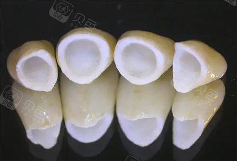 重庆深圳做全瓷牙到底要花多少钱？2026年最新报价揭秘