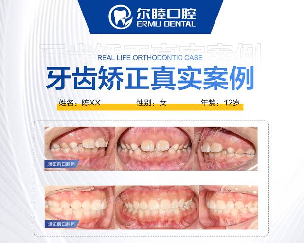 重庆深圳西乡牙齿矫正费用到底要多少钱？2026年最新价格参考