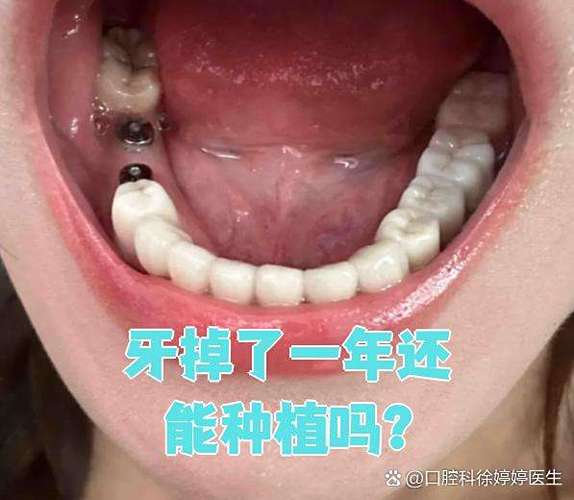 重庆牙齿掉了还能种吗？现在种牙靠谱不靠谱
