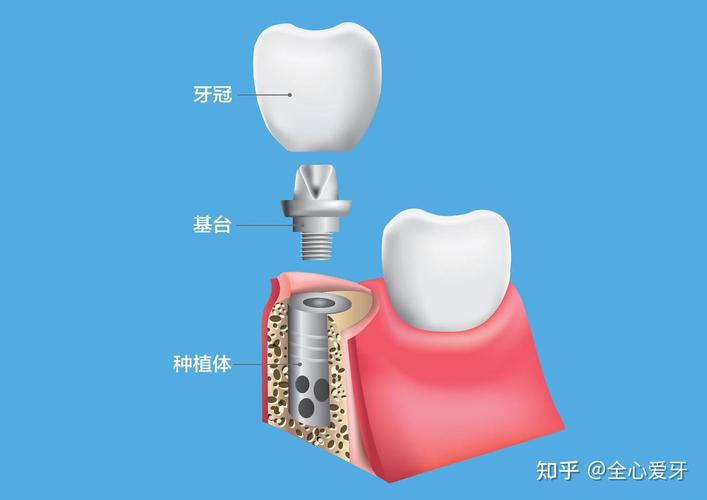 重庆佛山种植牙集采后4500元全包靠谱吗 2026最新解读