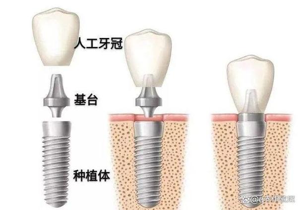 重庆集采种牙和自费种牙到底差在哪