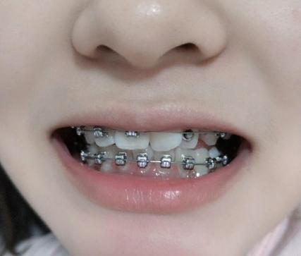 重庆30岁做牙齿矫正有什么后遗症?看完这篇不踩坑