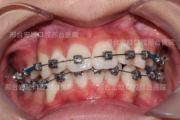 重庆不整齐牙齿矫正到底要花多少钱？大概多久能好？
