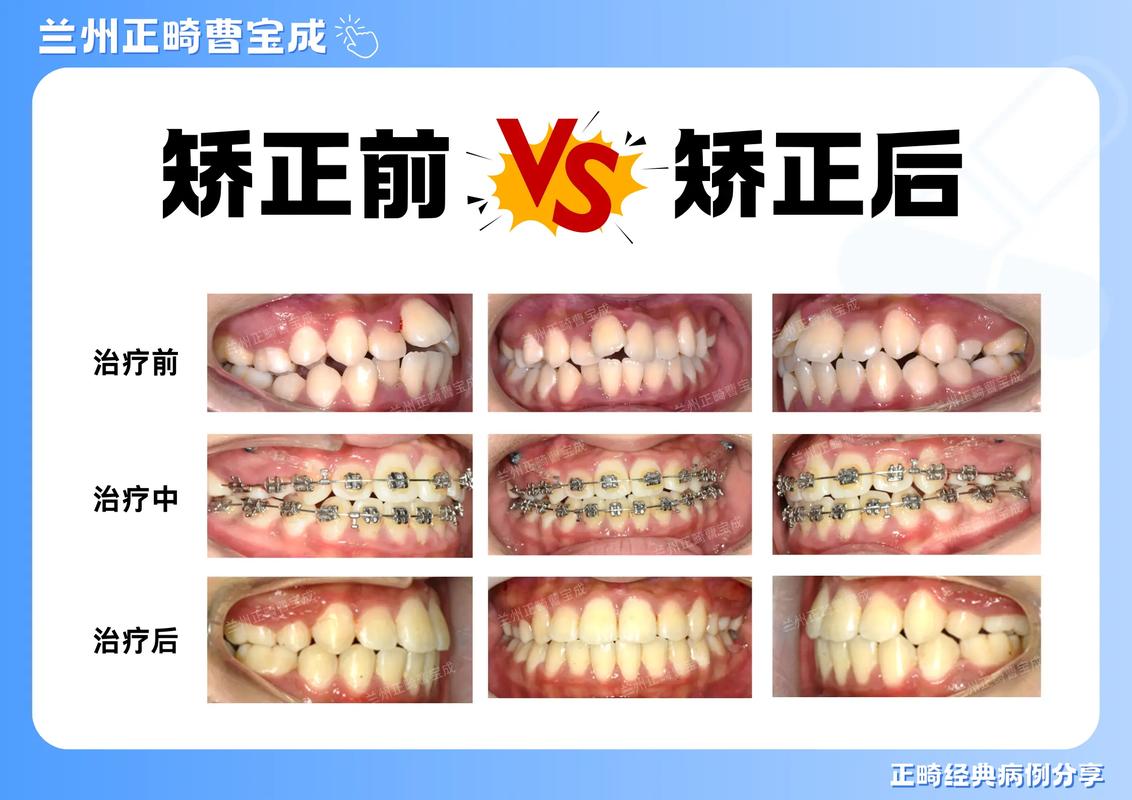 重庆35岁做牙齿正畸晚吗？成人矫正前先看这3点