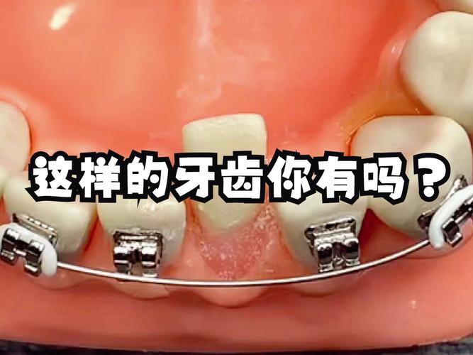 重庆8岁小孩牙齿歪了能矫正吗 家长别错过最佳时机