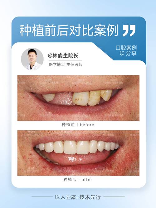 重庆深圳坪山种一颗牙多少钱 价格明细来了
