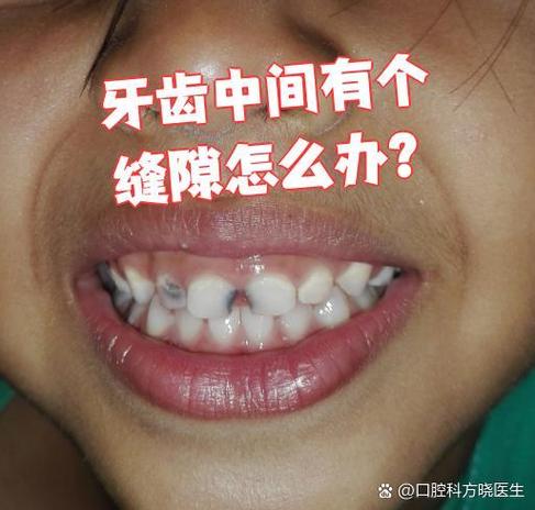 重庆门牙有缝怎么矫正？这几种方法亲测有效