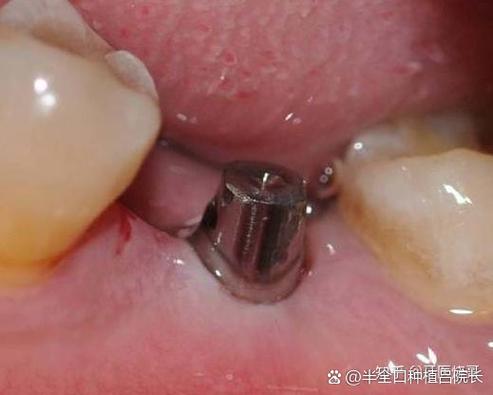 重庆65岁老人牙齿还能种吗？种牙靠谱吗